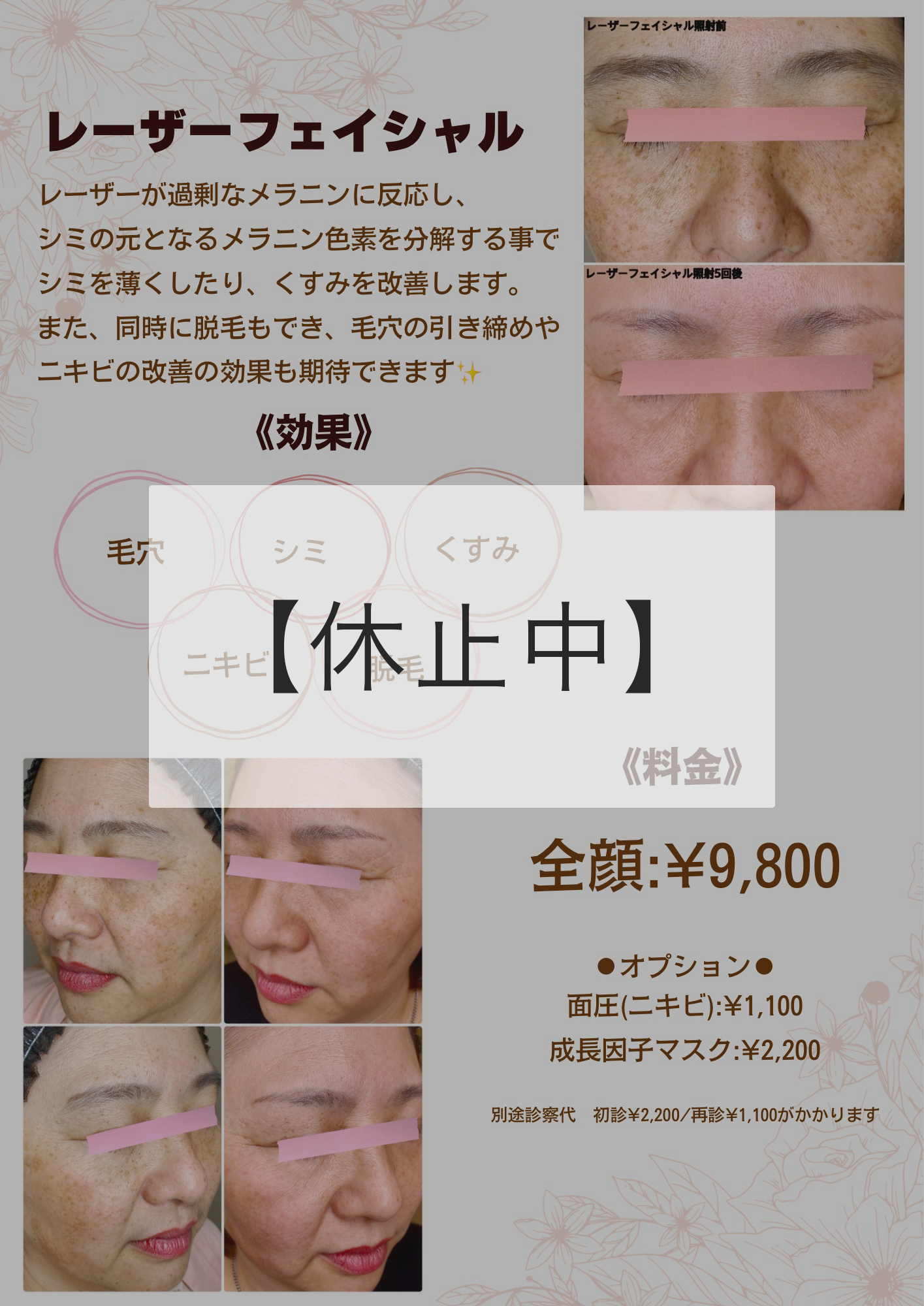 レーザーフェイシャル